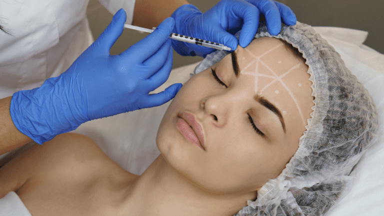 The science behind flawless skin with Microneedling